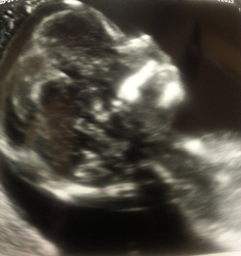 An ultrasound showing the baby in the stomach of the pregnant woman
