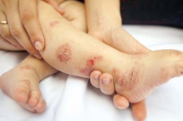 11 Signs You Should Get Your Child's Rash Checked Out