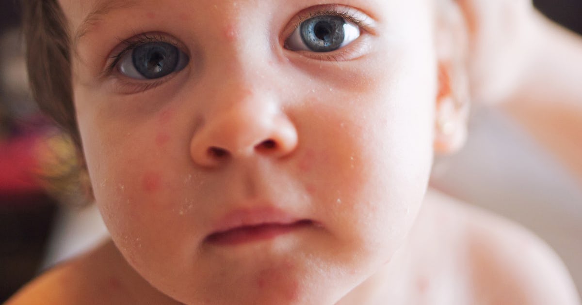 11 Signs You Should Get Your Child's Rash Checked Out