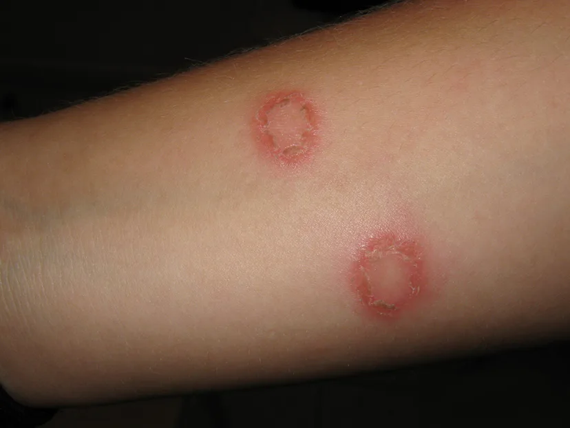 Cartwheel Rash 11 Signs You Should Get Your Child's Rash Checked Out