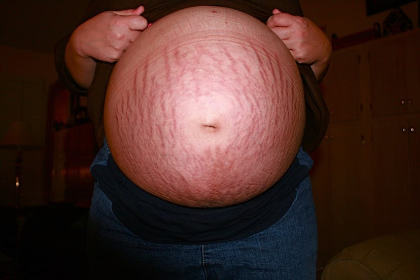 A pregnant woman's stomach with many visible stretch marks
