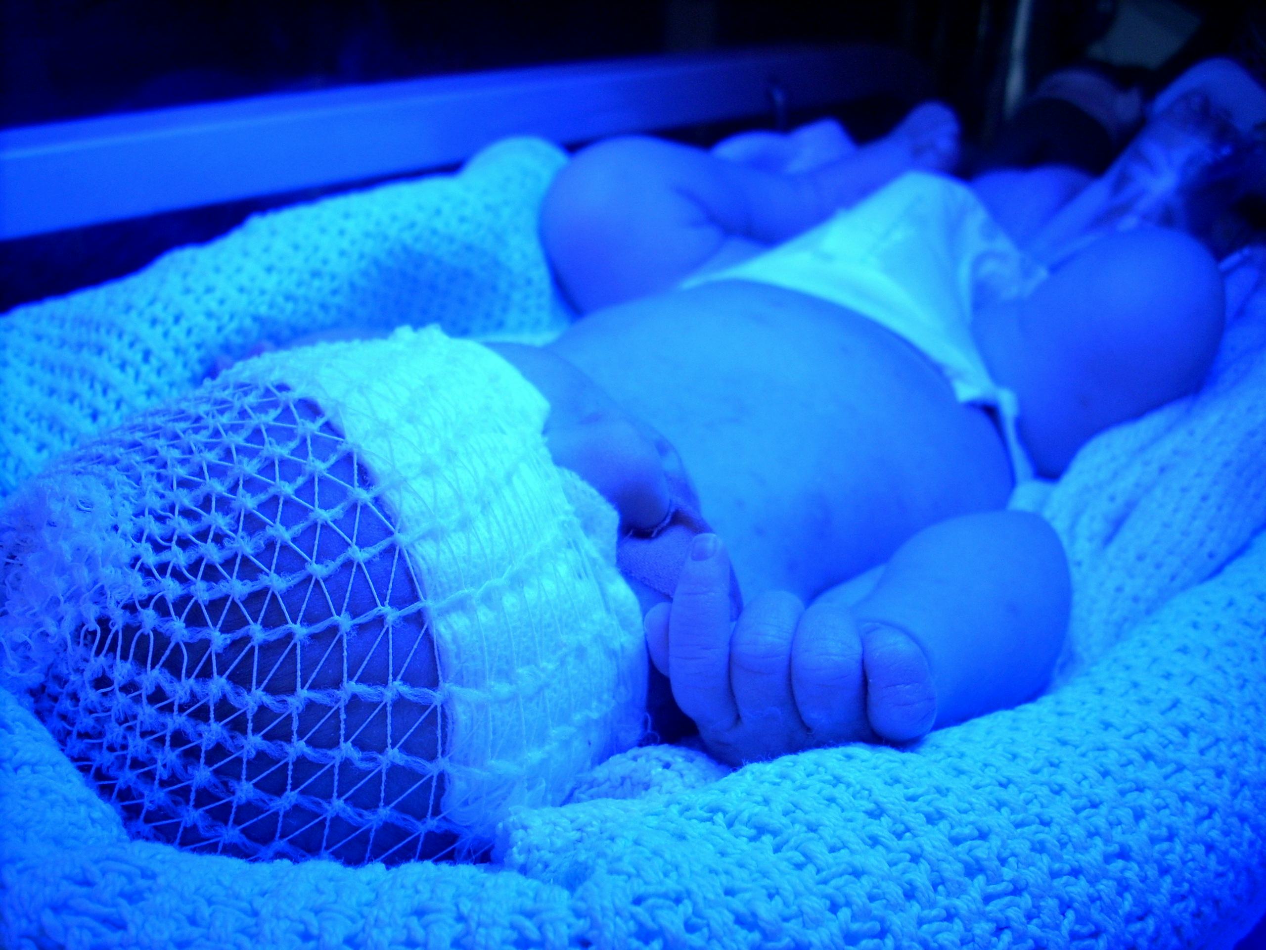 Why Do Babies Have Jaundice? 5 Things To Know About Skin Discoloration