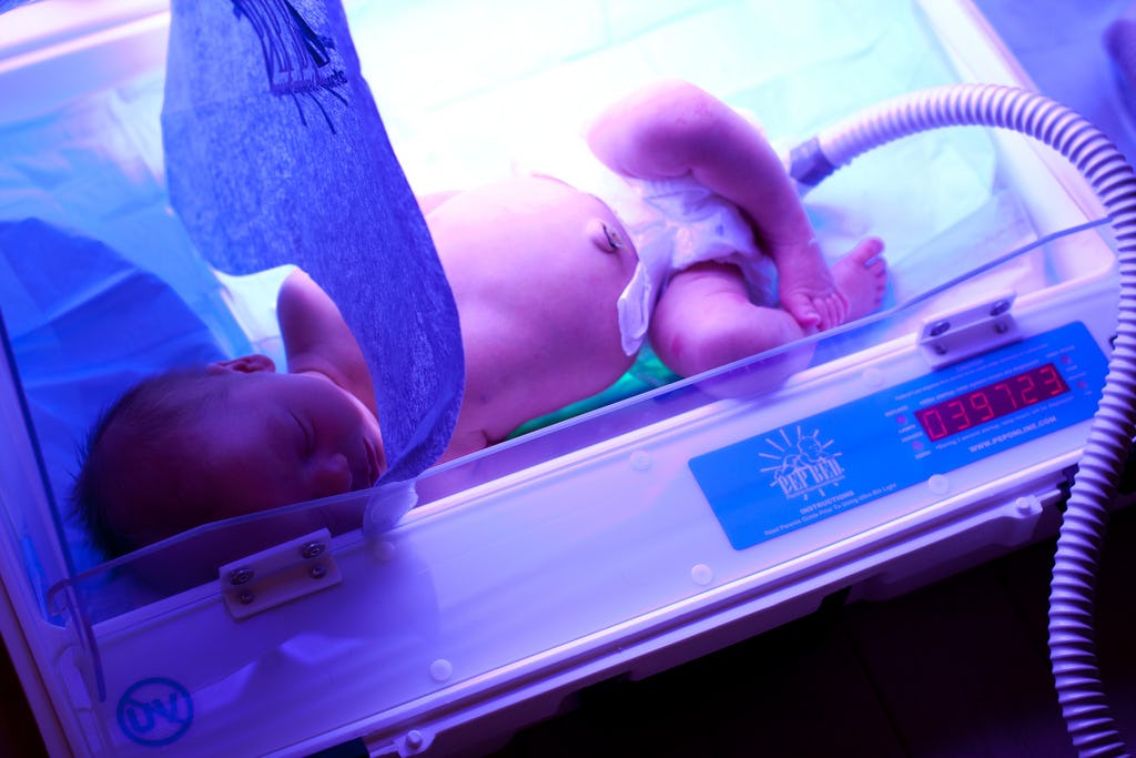 Why Do Babies Have Jaundice? 5 Things To Know About Skin Discoloration