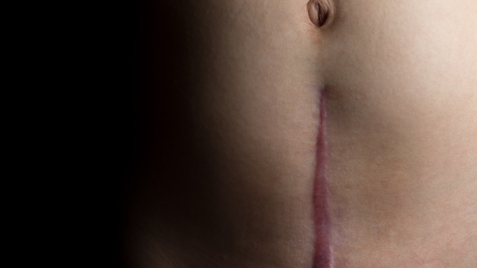 How Long Does It Take To Heal After A C-Section? How Long Does It Take To Heal After A C-Section?