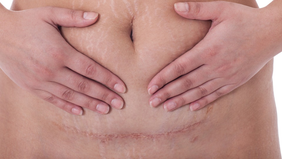 11 C-Section Recovery Tips That'll Ease The Post-Op Pain 11 C-Section Recovery Tips That'll Ease The Post-Op Pain