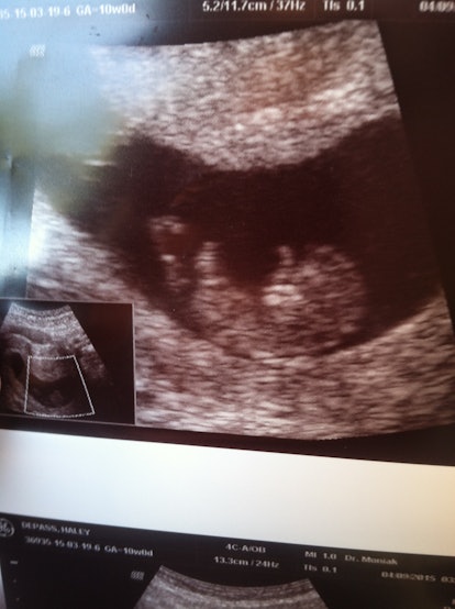 Haley DePass' ultrasound