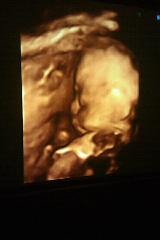View of a baby on ultrasound