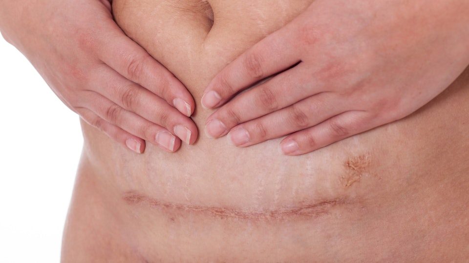 How Long Does It Take To Heal After A C-Section? How Long Does It Take To Heal After A C-Section?
