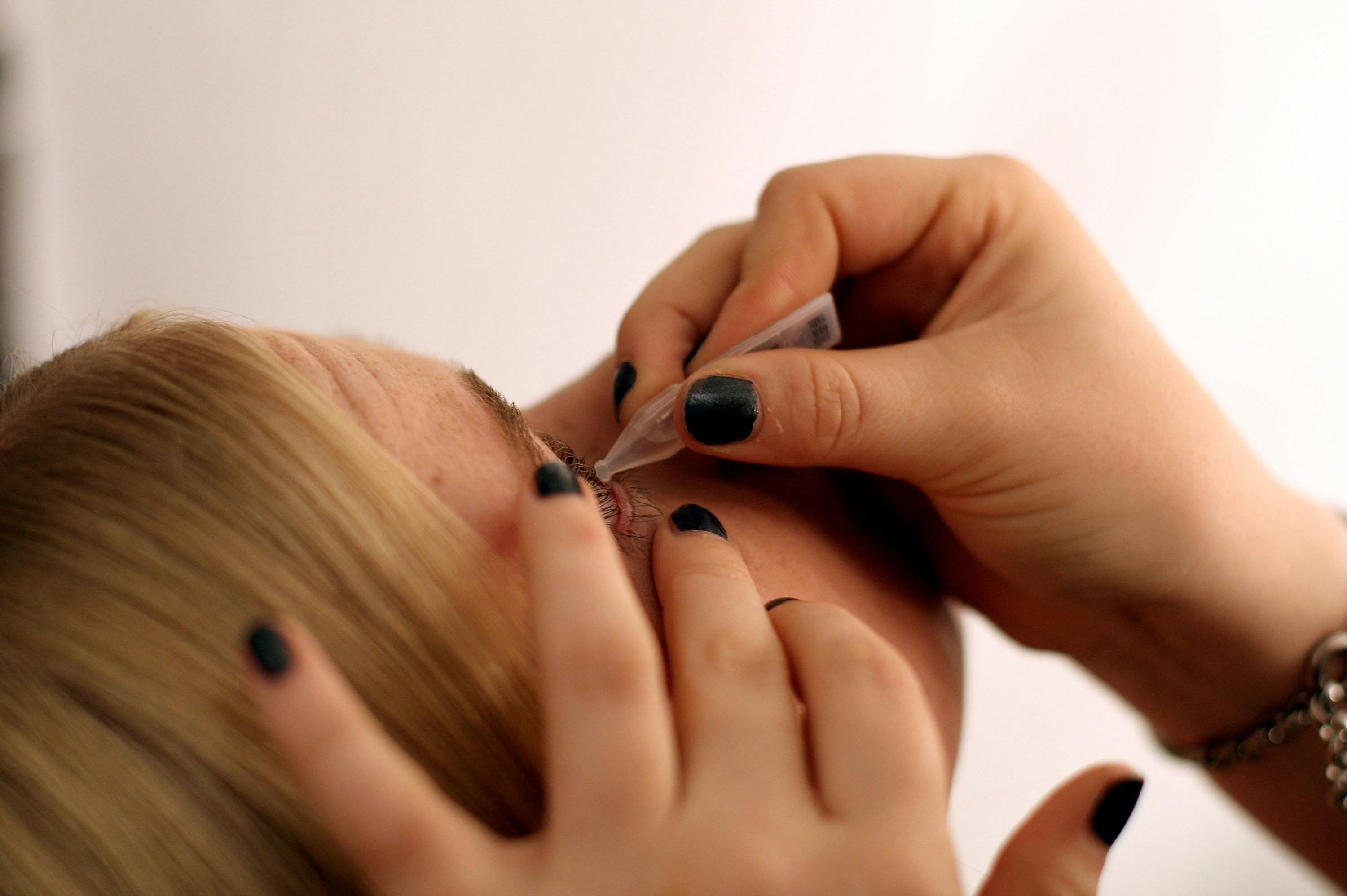 How To Get Rid Of Bloodshot Eyes Caused By Allergies, According To The