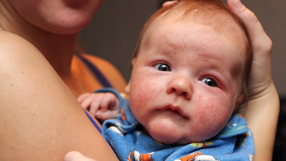 Does Coconut Oil Help Baby Eczema The Results May Surprise You