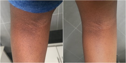 Before and after pictures showing the result of one person using Hemp seed oil for eczema
