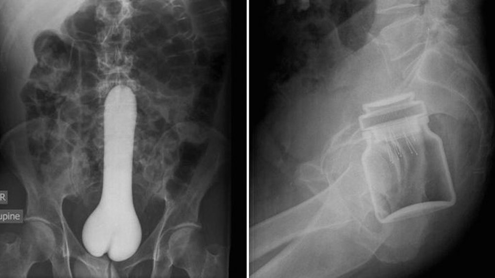 Website Compiles X Ray Photos Of Weird Things Stuck Up