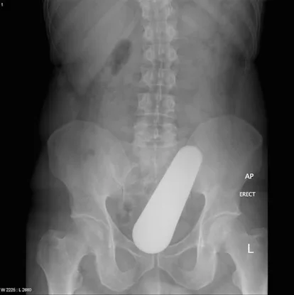 Stuck Up X Rays Website Compiles X-Ray Photos Of Weird Things Stuck Up People's Butts