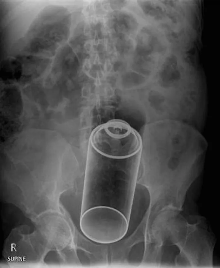 Stuck Up X Rays Website Compiles X-Ray Photos Of Weird Things Stuck Up People's Butts