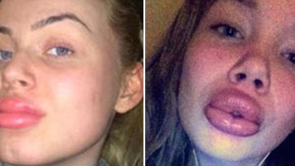 Girls Use A Water Bottle To Get Kylie Jenner Lips And Fail Miserably