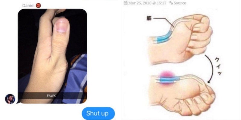tell if your thumb is dislocated