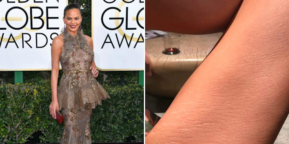 Chrissy Teigen Tweets Close Up Photo Of Her Stretch Marks 