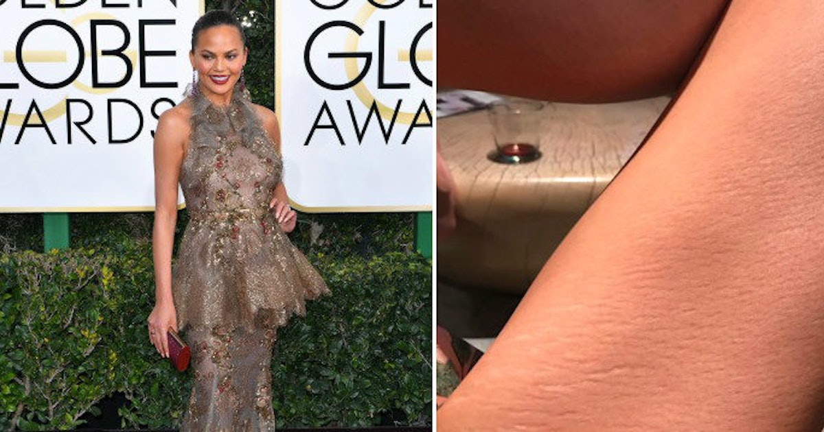 Celebrities With Stretch Marks On Legs