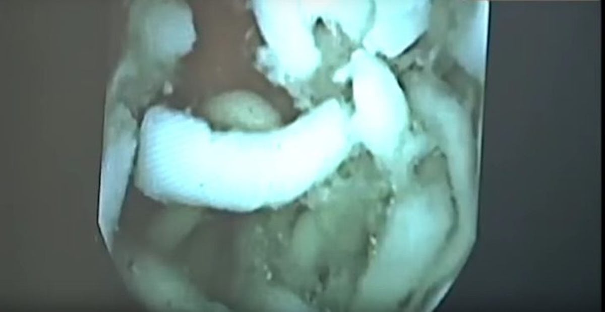 Video Of Ramen Noodles Inside Stomach Is Gross