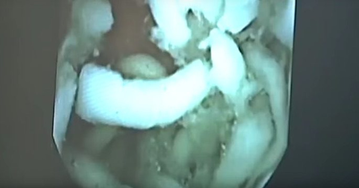 Video Of Ramen Noodles Inside Stomach Is Gross