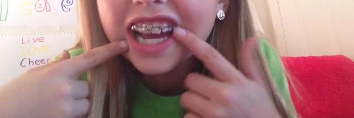 Tweens are making braces out of paper clips, rubber bands — and  predictably, it's damaging their teeth