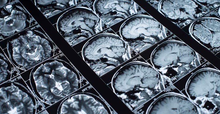 mri brain scans