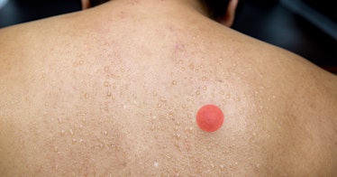 Man with pimple on his back.