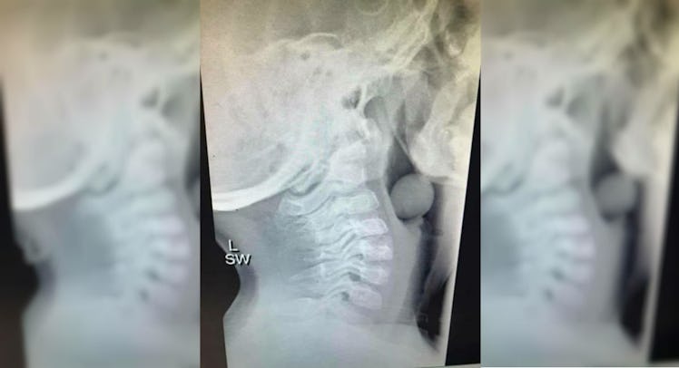 A three-part collage of an X-ray of a grape lodged in a kid's throat that went viral