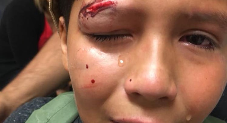 Full-profiled hurt boy with a swelling and bruise on his left temple who refused to fight bullies