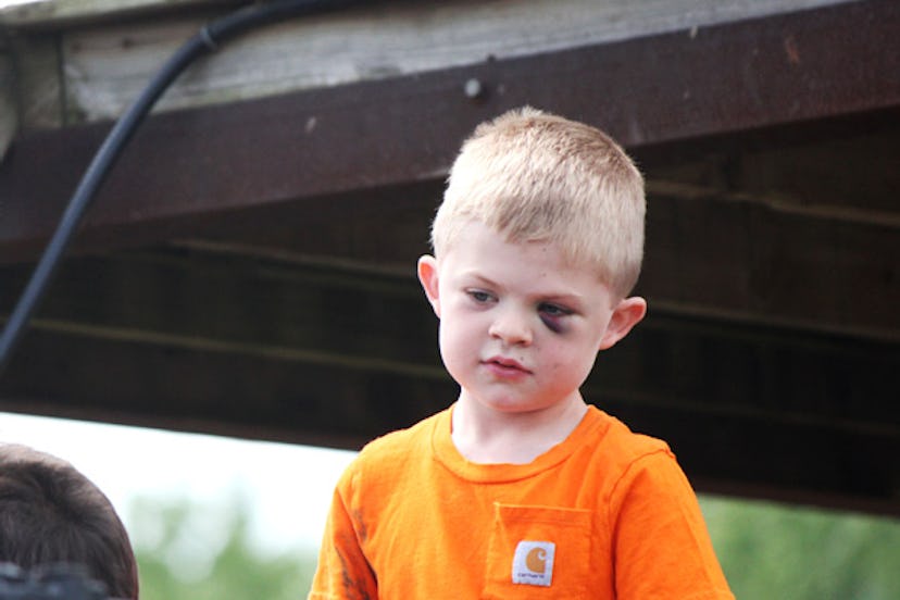 A little boy with a bruise after mutton busting