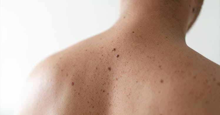 close up shot of the back of a man with skin cancer