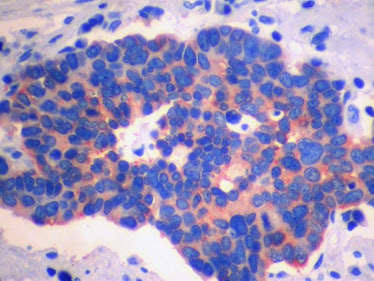Small cell lung carcinoma, chromogranin immunostain