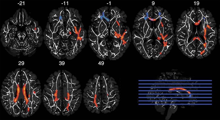 brain scans frontal white matter