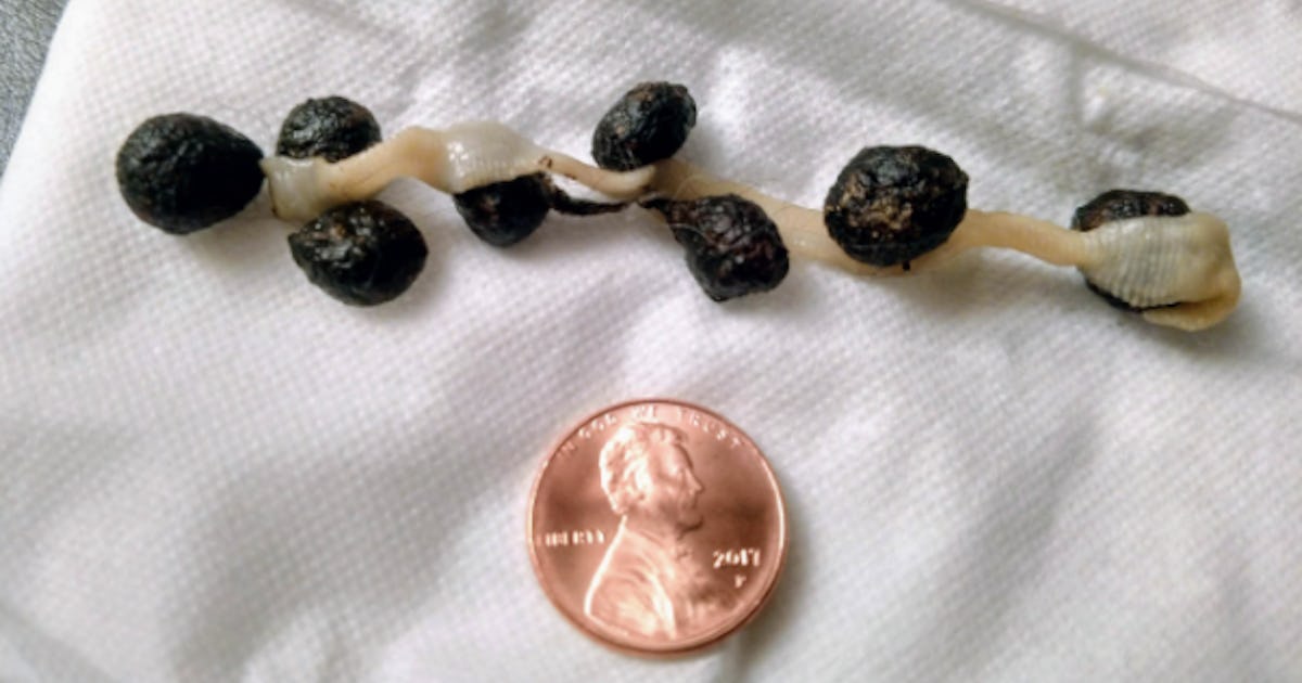 Tapeworm Segments In Human Stool Pictures : How To Prevent Tapeworms By