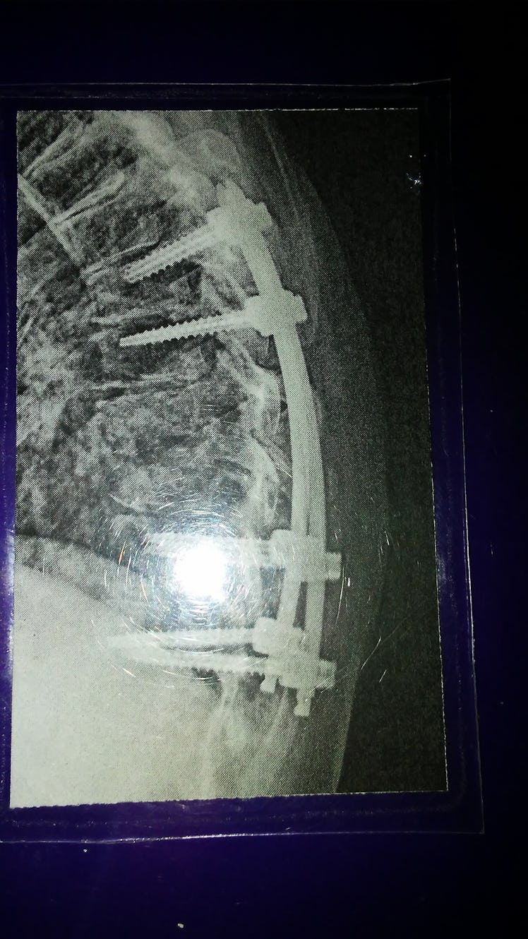 Teem had thoracic spinal fusion surgery, which required screws and rods to be placed in her back to ...