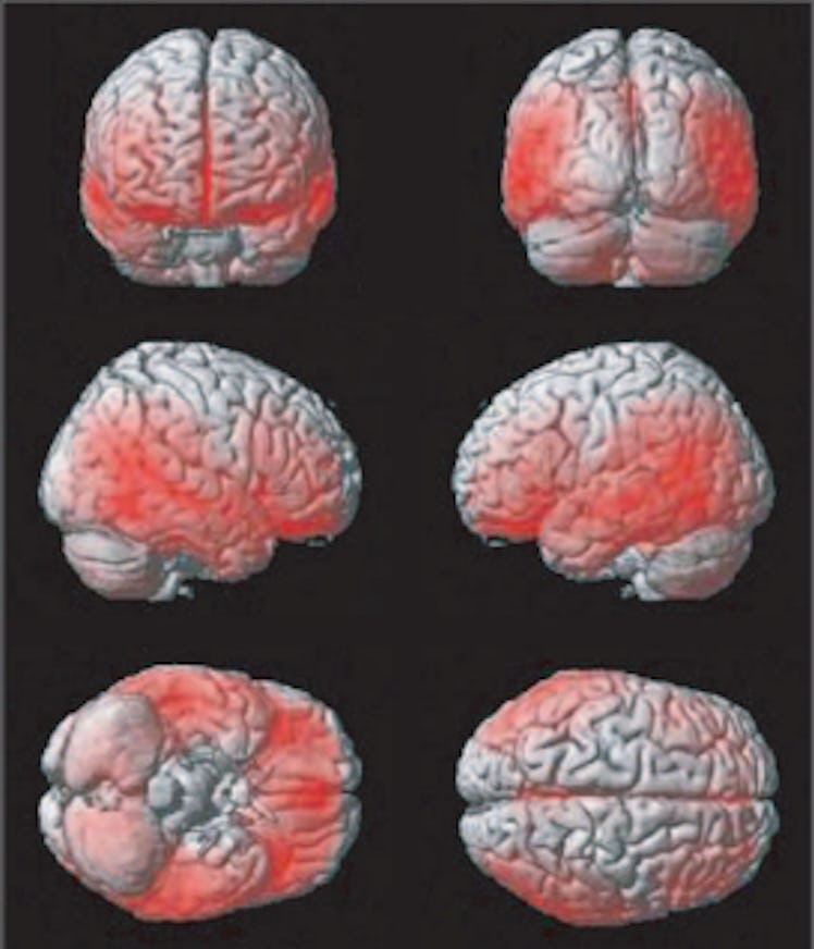 brain scans, teens 