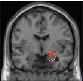 A brain scan highlighting the location of the amygdala.