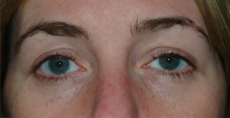 UK Woman Had Contact Lens Lodged in Her Eye for 28 Years