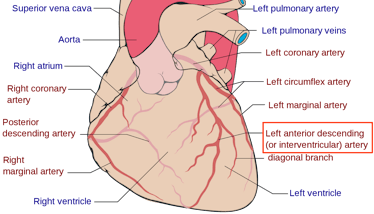 LAD artery heart attack