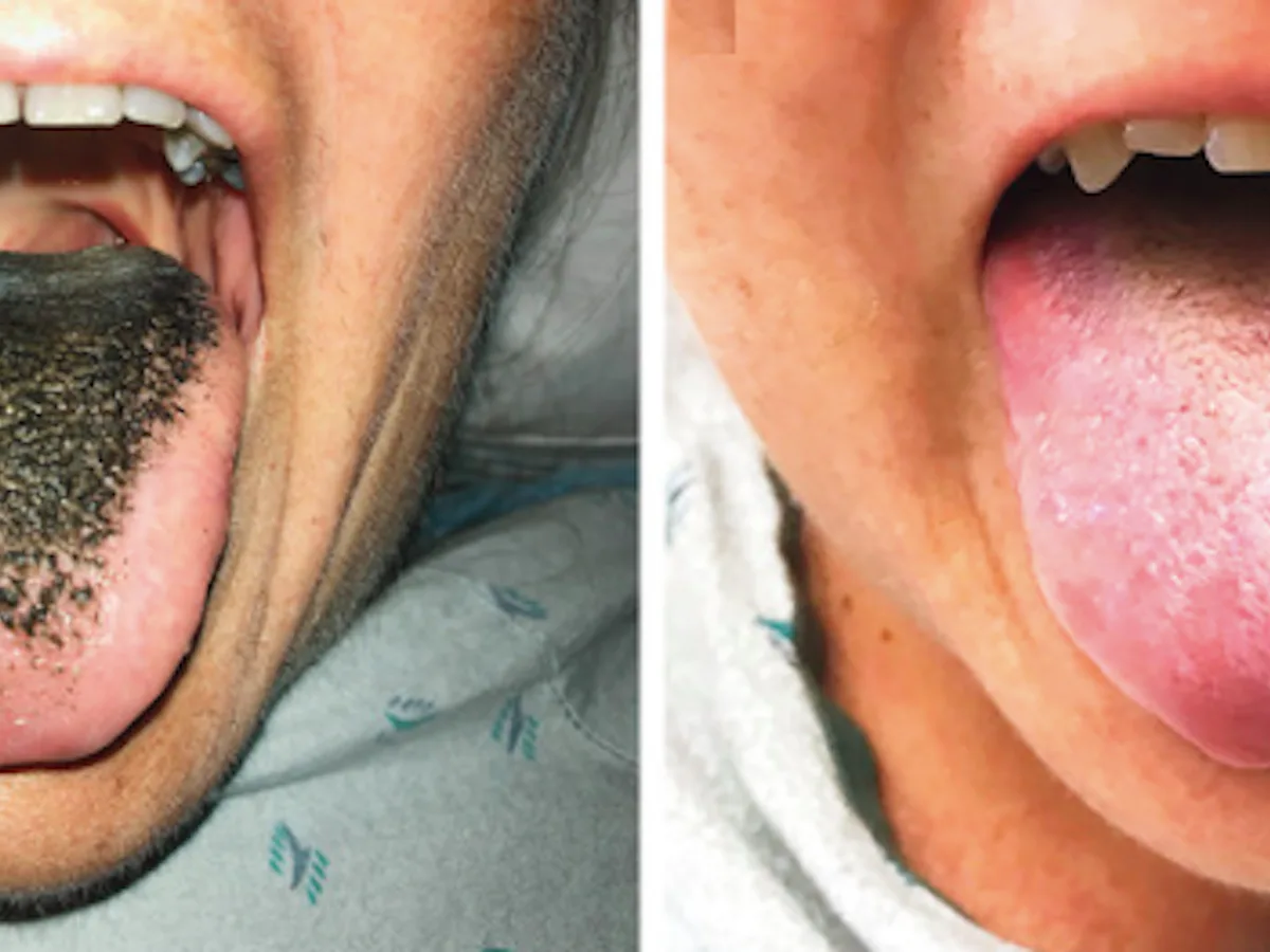 tobacco hairy tongue Black What Is Black Hairy Tongue?