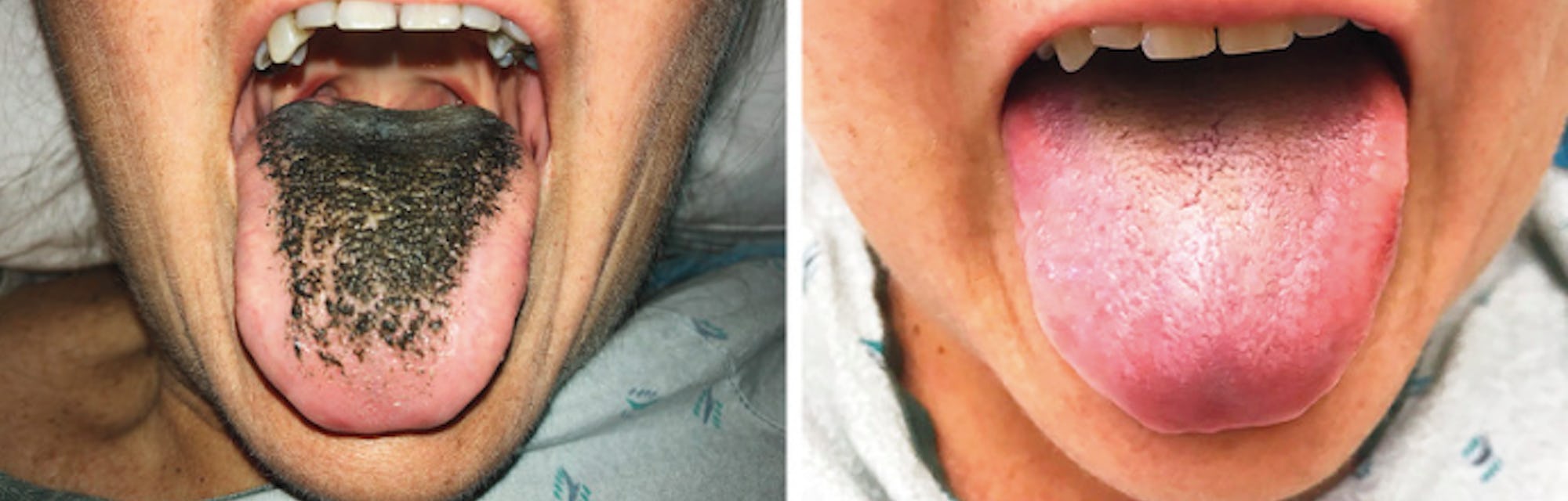 What Is Black Hairy Tongue It Looks Gross But The Oral Condition Is Safe What Is Black Hairy Tongue It Looks Gross But The Oral Condition Is Safe