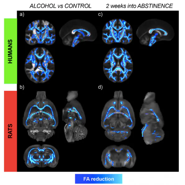 Alcohol Still Hurts Brain's White Matter 6 Weeks After a Person Gets Sober