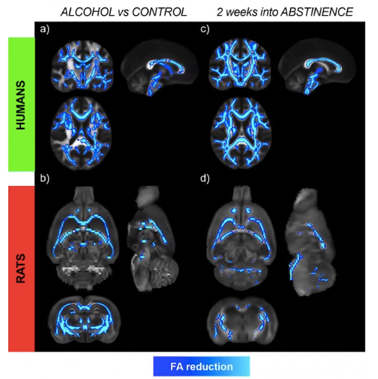 brain, alcohol