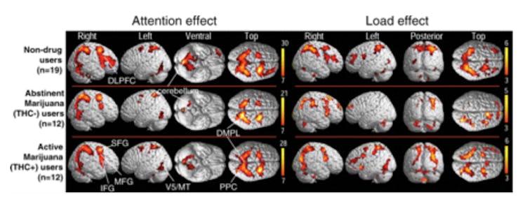 Statistical parametric maps of BOLD signals in abstinent marijuana users (THC−), active marijuana us...