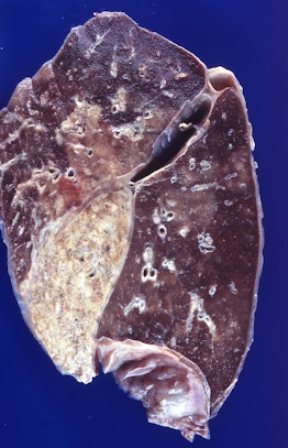 A lung with cryptococcal infection.