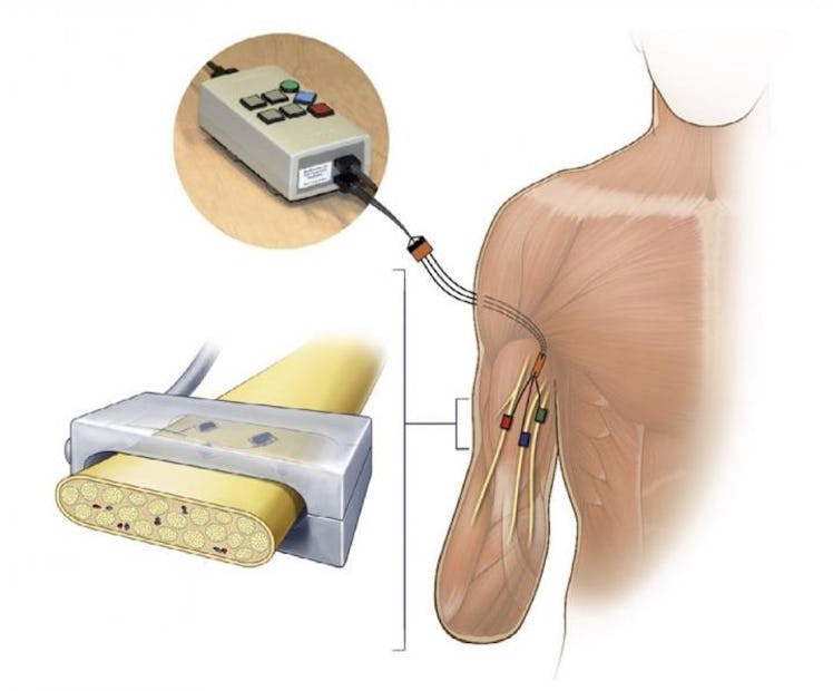 Electrical stimulation was delivered by an external stimulator (top left) through percutaneous leads...