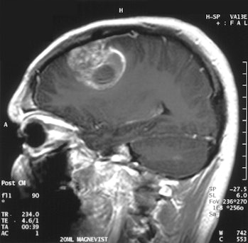 Glioblastoma is an aggressive form of brain cancer.