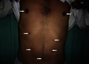 The Scientific Reason Harry Styles and Other People Have 4 Nipples The Scientific Reason Harry Styles and Other People Have 4 Nipples