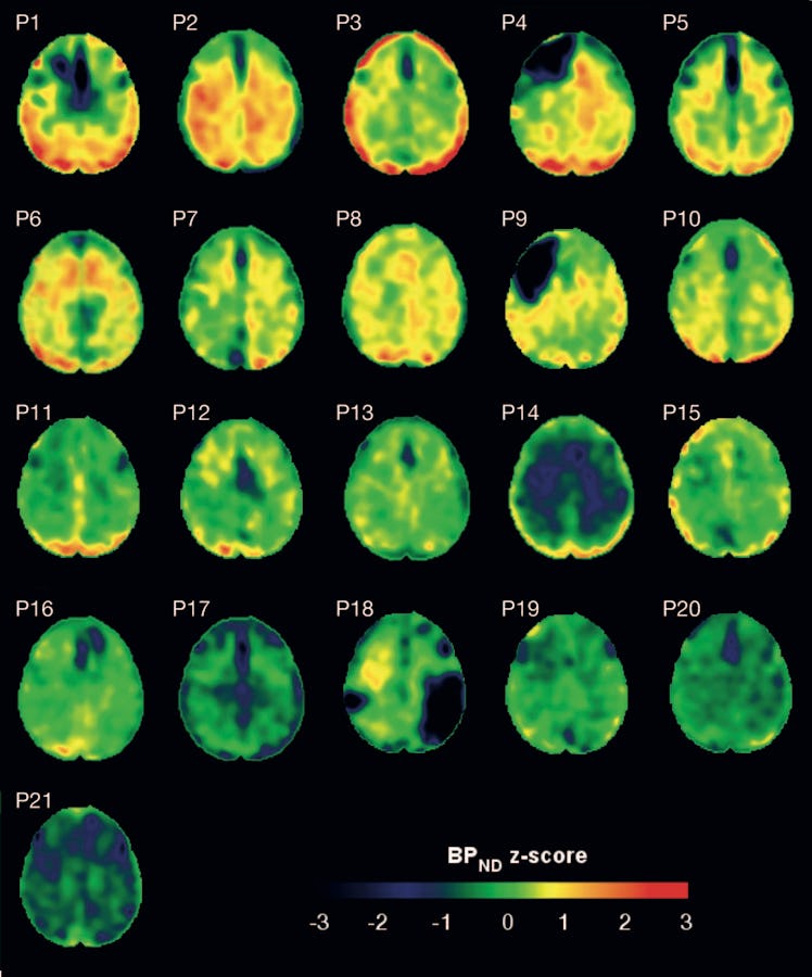 The brains with higher levels of tissue altered by TBI show more positive values (yellow to red), wh...