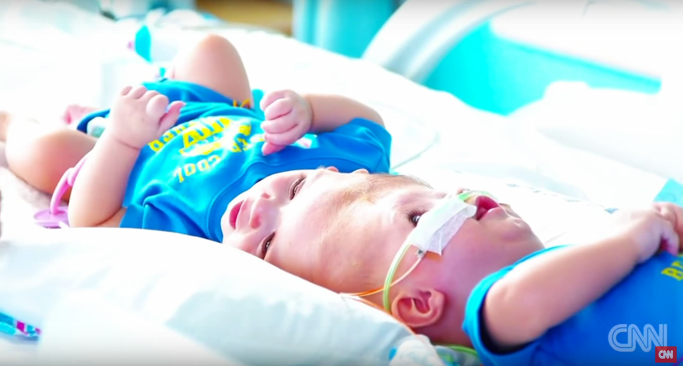 Conjoined Twins To Be Separated In Rare Surgery